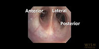 Intro to Bronchoscopy: Lower Airway Anatomy
