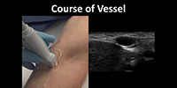 Ultrasound-Guided Peripheral Vascular Access